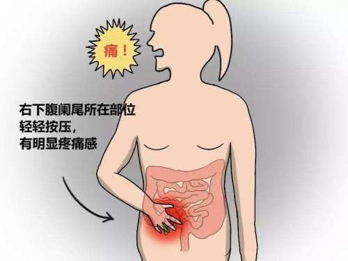 突发阑尾炎应对：突发阑尾炎吃什么药 